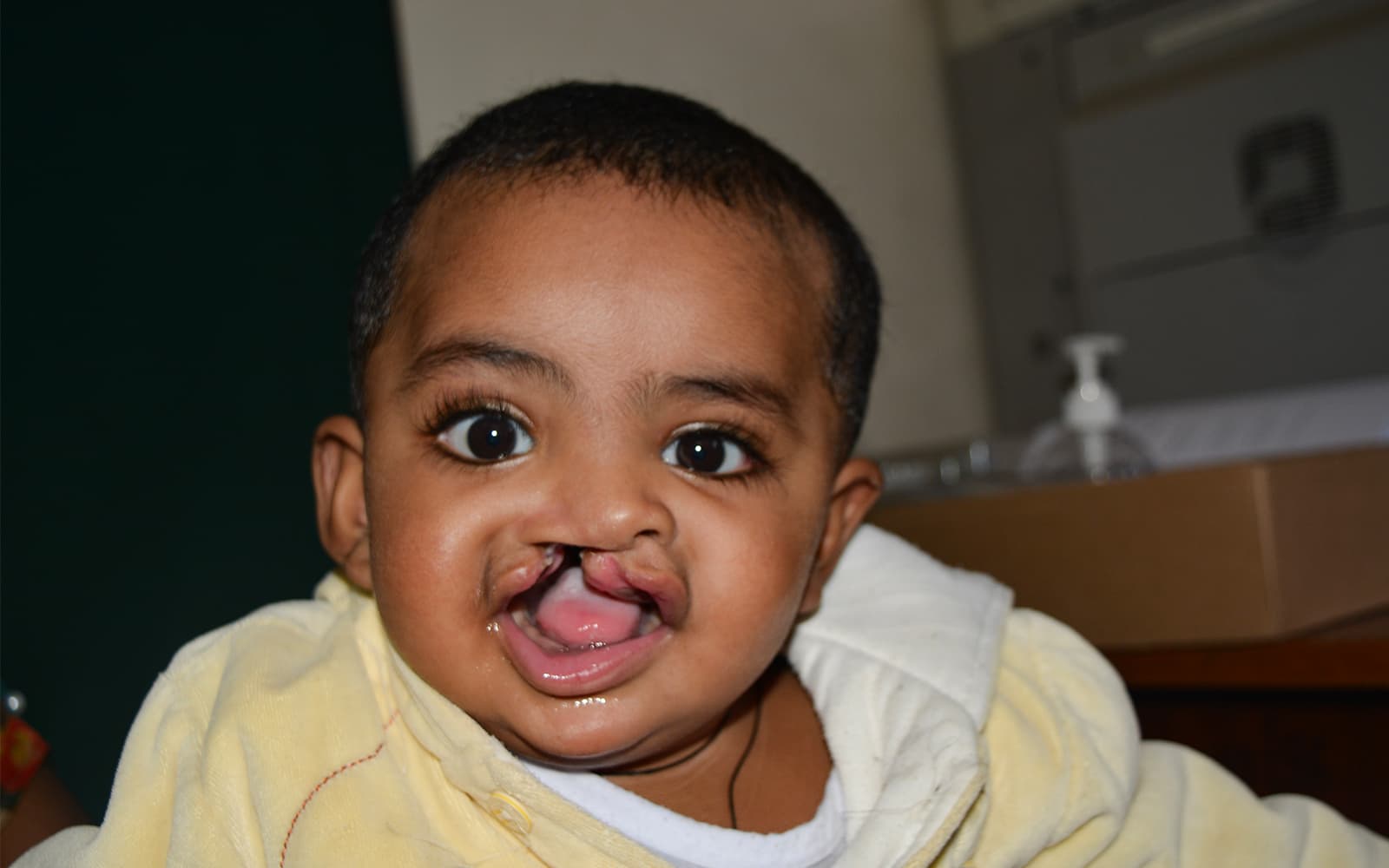 A baby boy with big black eyes and a cleft palate is looking at the camera.