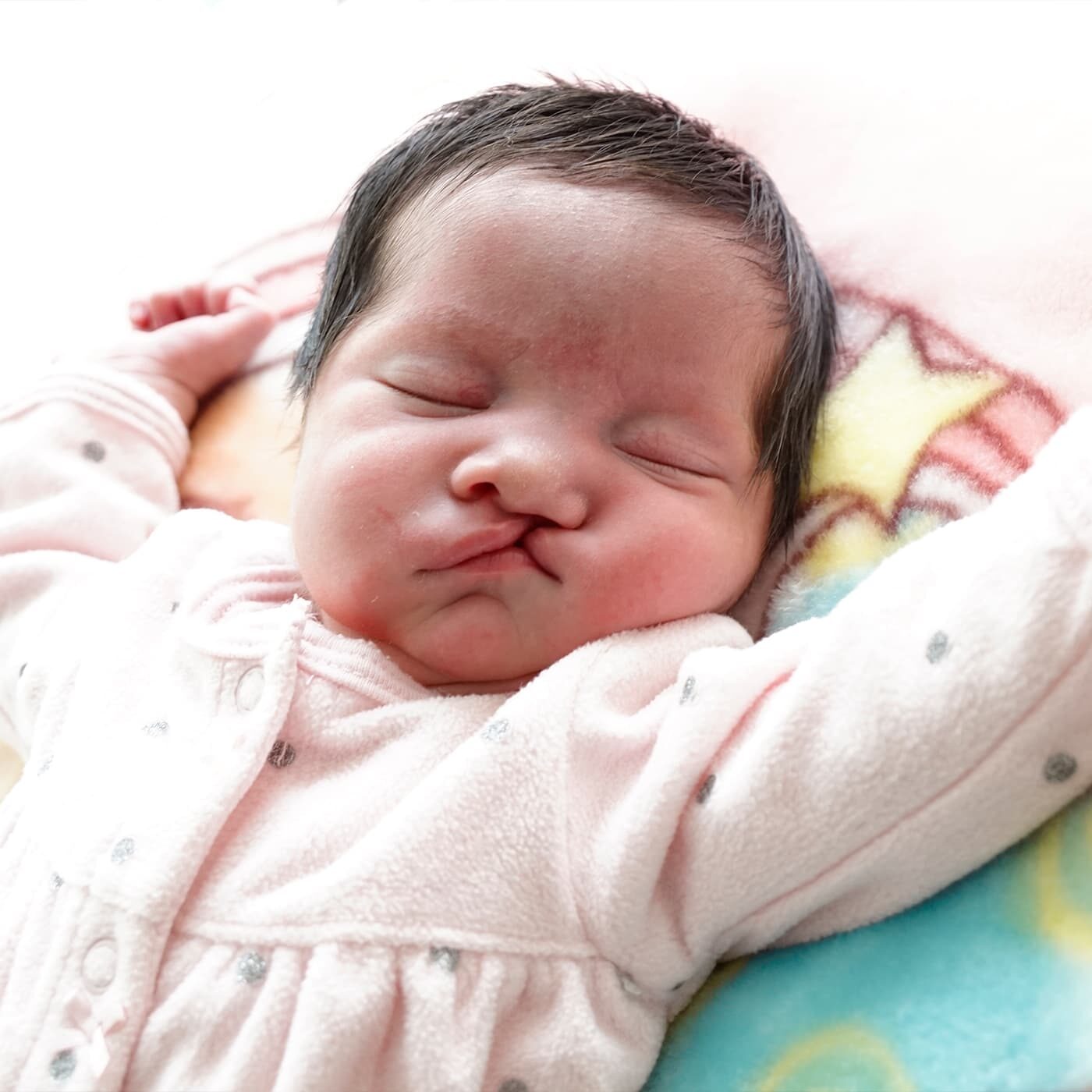 Sleeping baby with a cleft lip